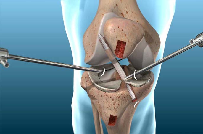 ACL Reconstruction