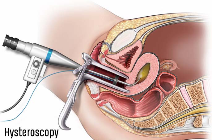 Hysteroscopy 