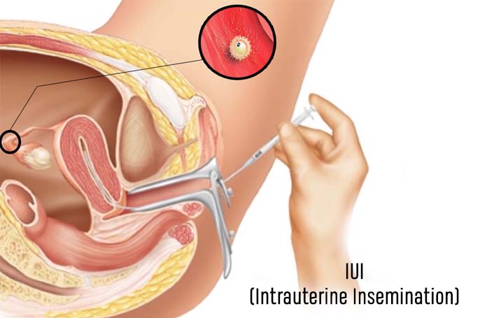 iui