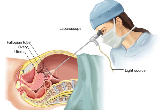 Laproscopy 