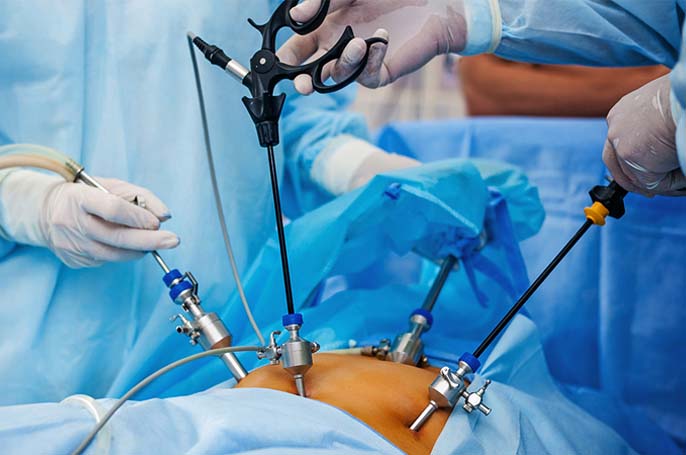 Laproscopy